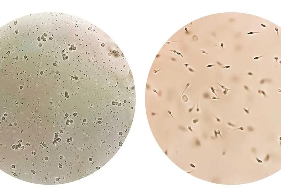 Microphotographie d'azoospermie à gauche et de normospermie à droite