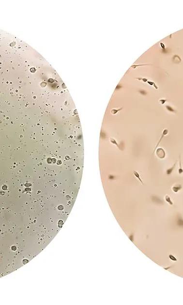 Microphotographie d'azoospermie à gauche et de normospermie à droite