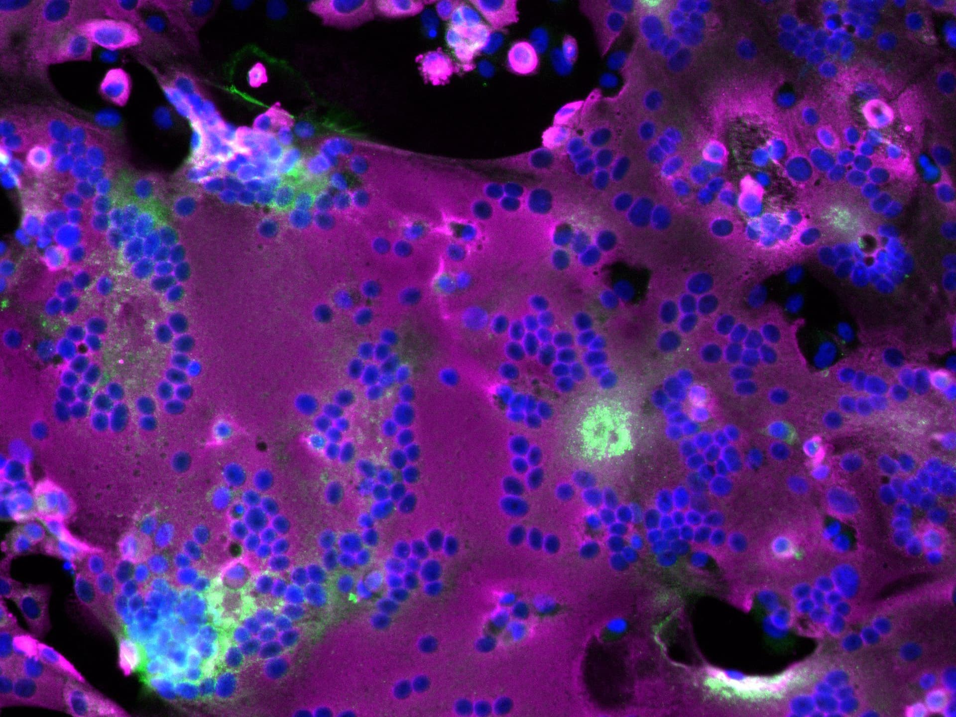 Covid long : une infection persistante dans le cerveau et des ...