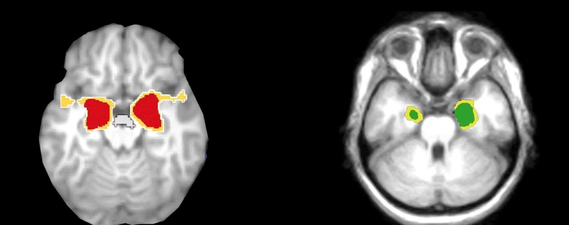 alzheimer