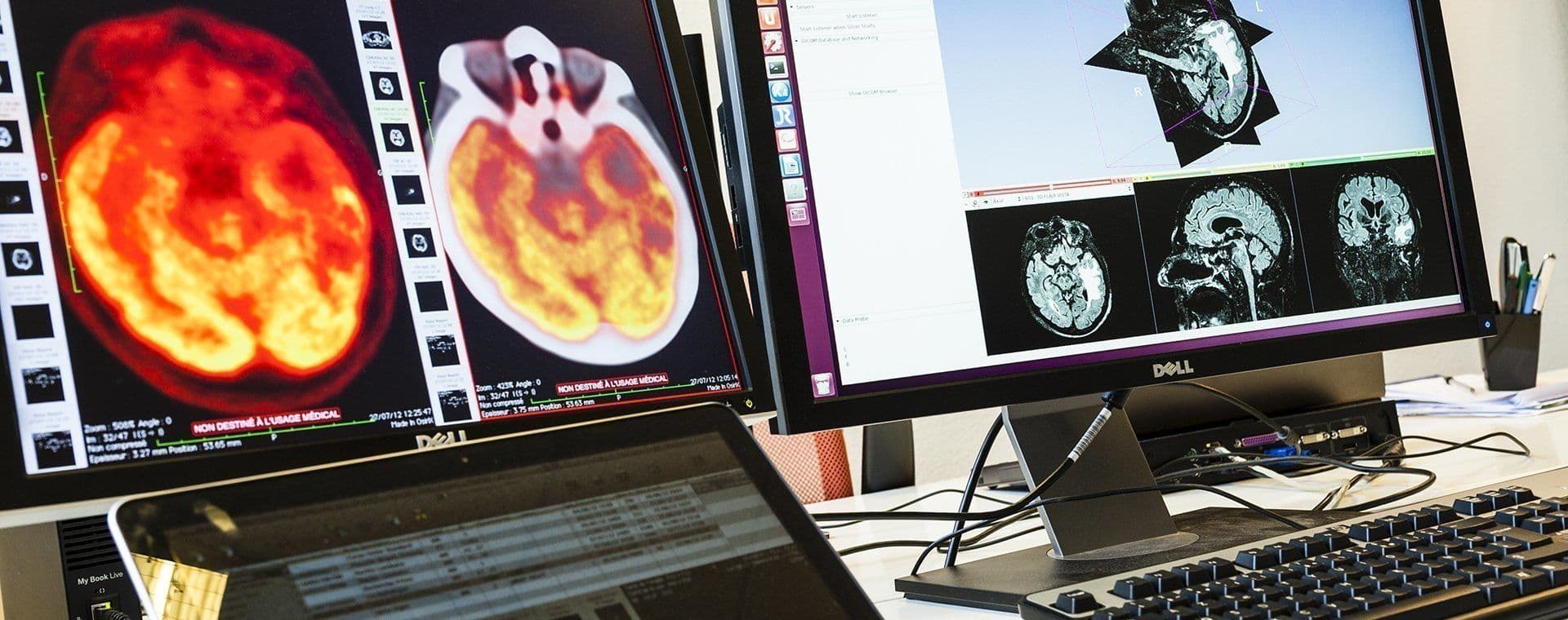 L’épilepsie, une maladie fréquente