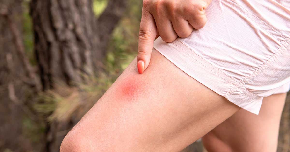 La borréliose de Lyme est provoquée par des bactéries transmises par piqûre de tique.