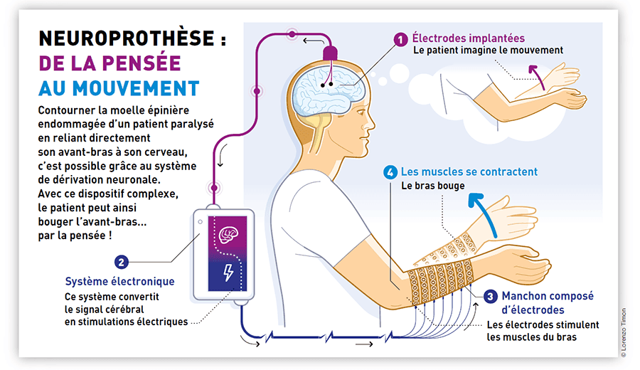 Neuroprothèse de la pensée au mouvement
