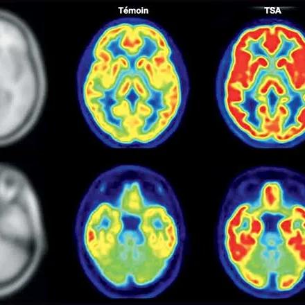 Sur ces représentations de l’activité cérébrale, on distingue, à droite et en rouge, une quantité plus élevée de récepteurs du glutamate chez le sujet avec TSA que chez le sujet témoin, au centre.