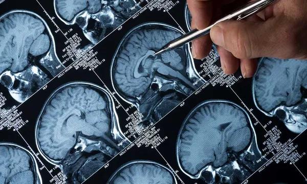 Scanner à résonance magnétique de cerveau