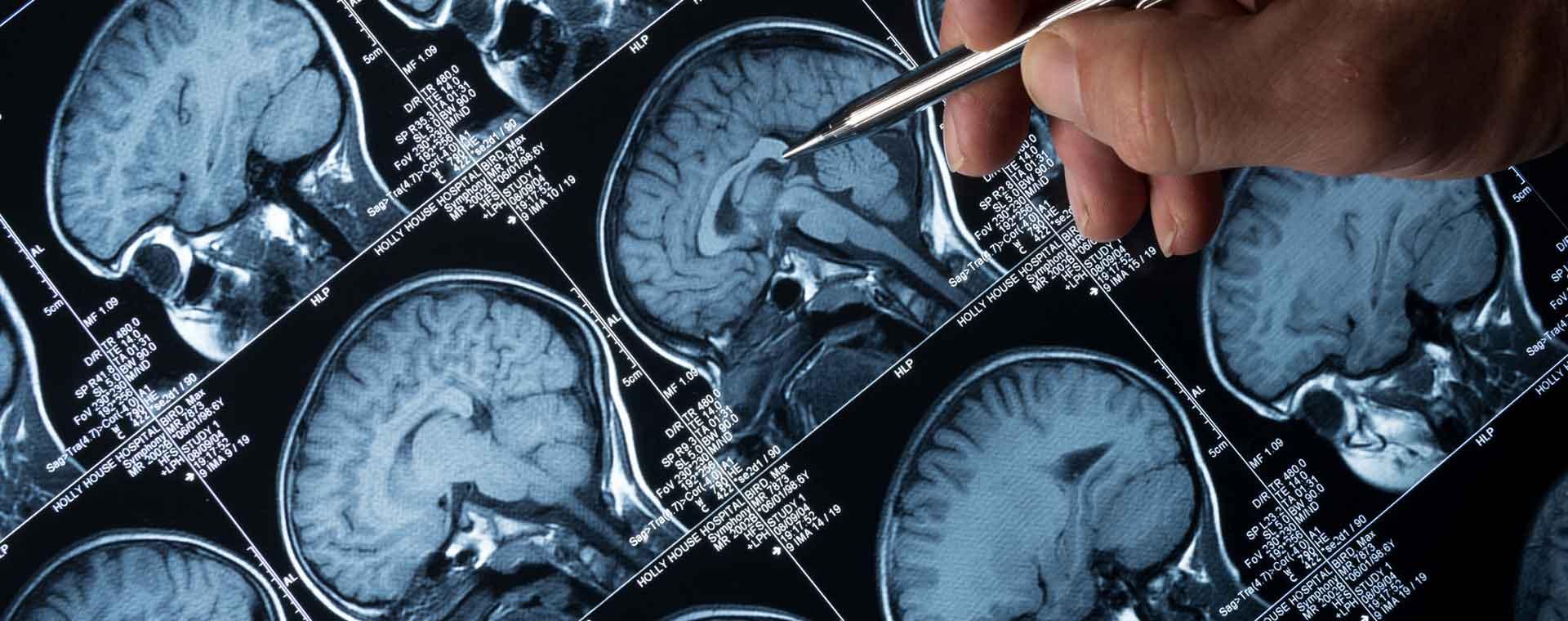 Imagerie cérébrale : percer les mystères du cerveau | Fondation ...
