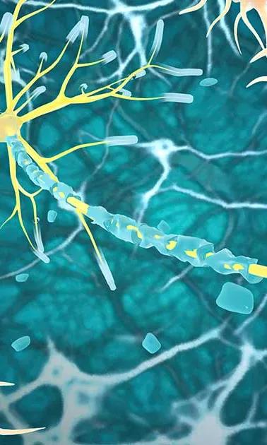 Illustration de la remyélinisation, phénomène par lequel de nouvelles gaines de myéline sont générées autour des axones du système nerveux central.