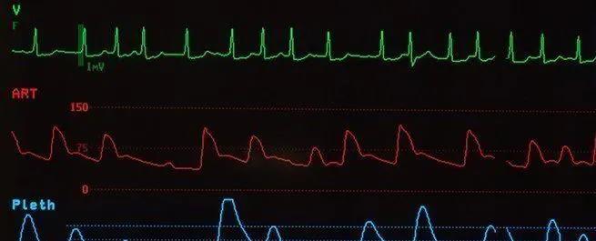 Troubles du rythme cardiaque : du nouveau dans la tachycardie ventriculaire polymorphe catécholaminergique