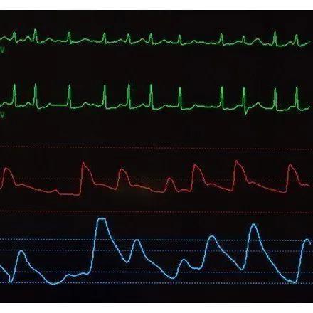 Troubles du rythme cardiaque : du nouveau dans la tachycardie ventriculaire polymorphe catécholaminergique