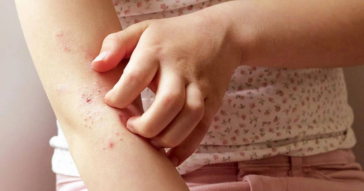 Pourquoi l'eczma de contact rapparat-il, et toujours au mme endroit ? | Fondation pour la Recherche Mdicale (FRM) Pourquoi l'eczma de contact rapparat-il, et toujours au mme endroit ? | Fondation pour la Recherche Mdicale (FRM)
